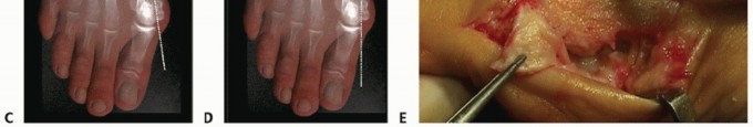 Illustration 14 for Mastering the Biplanar Distal Chevron for Effective Bunion Surgery
