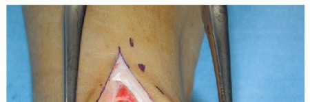 Illustration 8 for HINTEGRA Total Ankle: Unlocking Natural Ankle Movement