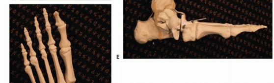 Illustration 16 for Regain Mobility: Surgical Solutions for Charcot Foot Arthropathy