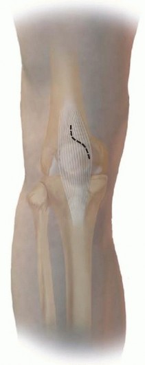 Illustration 23 for Optimizing Intramedullary Nailing for Tibial Shaft Fractures