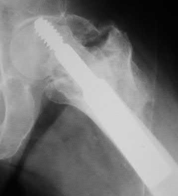 Illustration 51 for OrthoCash: Trauma MCQs & Cases for a yearold woman