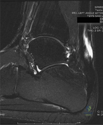 صورة توضيحية لـ نقل وتر الإبهام الطويل (FHL) لعلاج تمزق وتر العرقوب المزمن: دليل شامل للمرضى مع الأستاذ الدكتور محمد هطيف