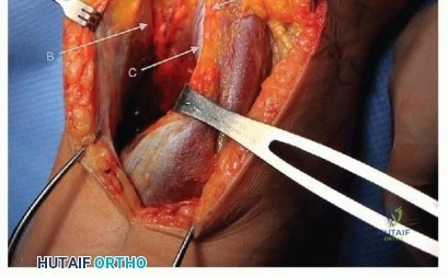Illustration of plateau fractures via - Dr. Mohammed Hutaif