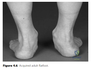 Illustration of acquired adult flatfoot - Dr. Mohammed Hutaif