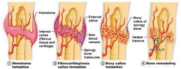 Fracture healing