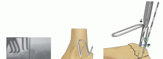 Closed reduction and casting techniques in fracture management