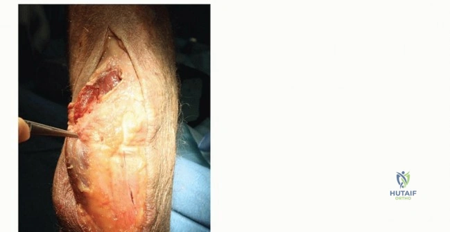 FRCS EMQs: Foot and ankle