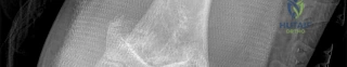 FRCS EMQs: Spine