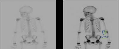 صورة توضيحية لـ خشونة وتصلب إبهام القدم (Hallux Rigidus): دليل المريض الشامل مع الدكتور محمد هطيف