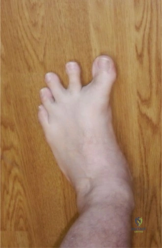 انحراف إبهام القدم للداخل (Hallux Varus): الأسباب، الأعراض، وطرق العلاج المتطورة في صنعاء مع الأستاذ الدكتور محمد هطيف