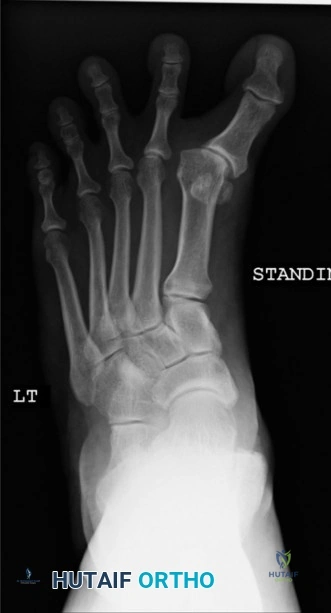 صورة توضيحية لـ انحراف إبهام القدم للداخل (Hallux Varus): الأسباب، الأعراض، وطرق العلاج المتطورة في صنعاء مع الأستاذ الدكتور محمد هطيف