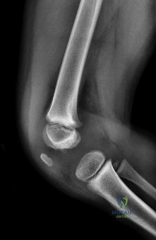 Deep Hand Infections: Clinical Presentation, Surgical Anatomy, and Management Strategies
