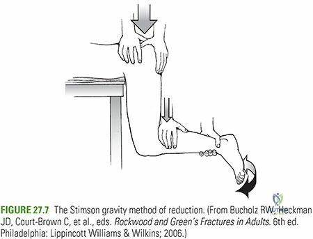 Illustration of hip dislocations hip - Dr. Mohammed Hutaif