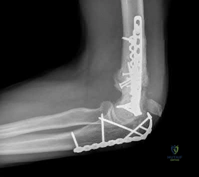 Proximal Humerus Malunion: Evaluation and Surgical Management