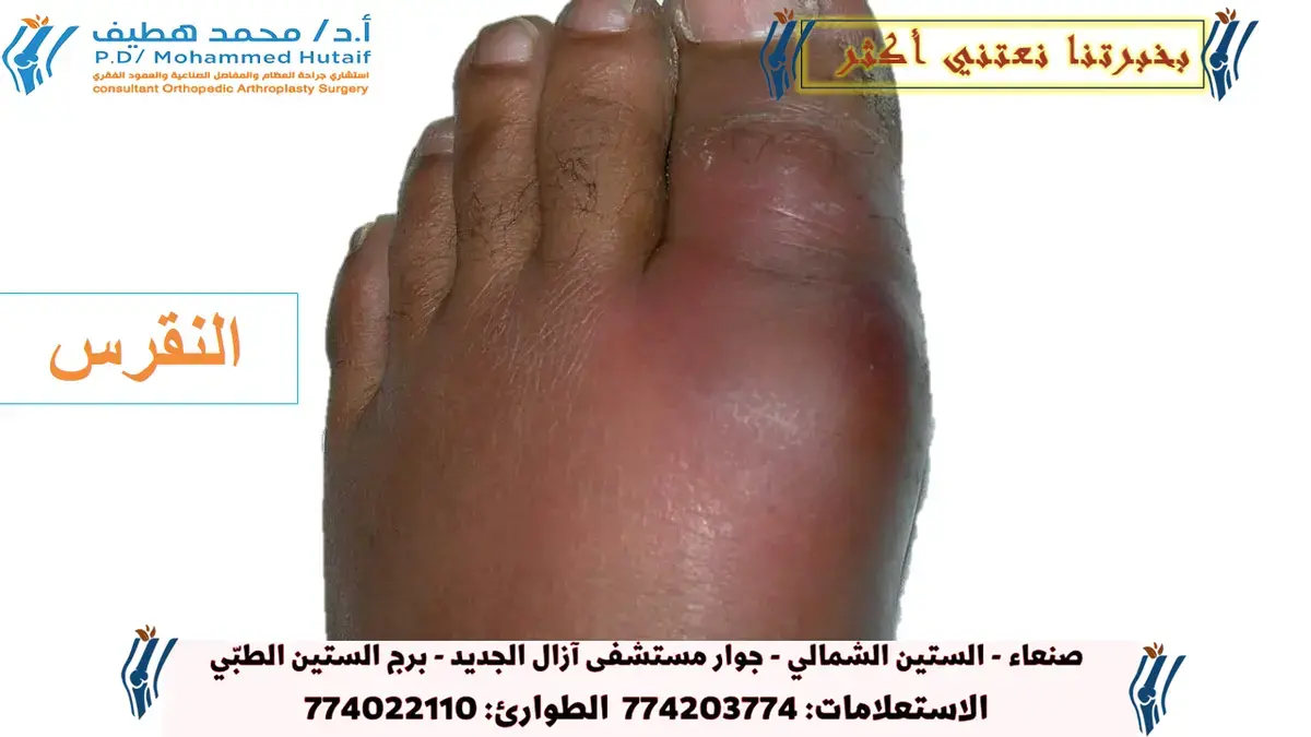 اكتشف الجذوع الفخذية المعيارية: مستقبل جراحة الورك المتقدمة.