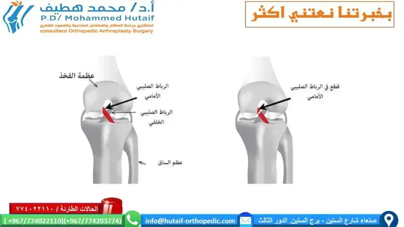 إتقان التثبيت الخارجي لعظم العضد: المسامير الآمنة والتقنيات الفعالة