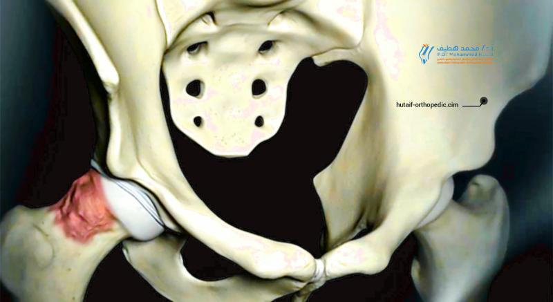 اصطدام الورك