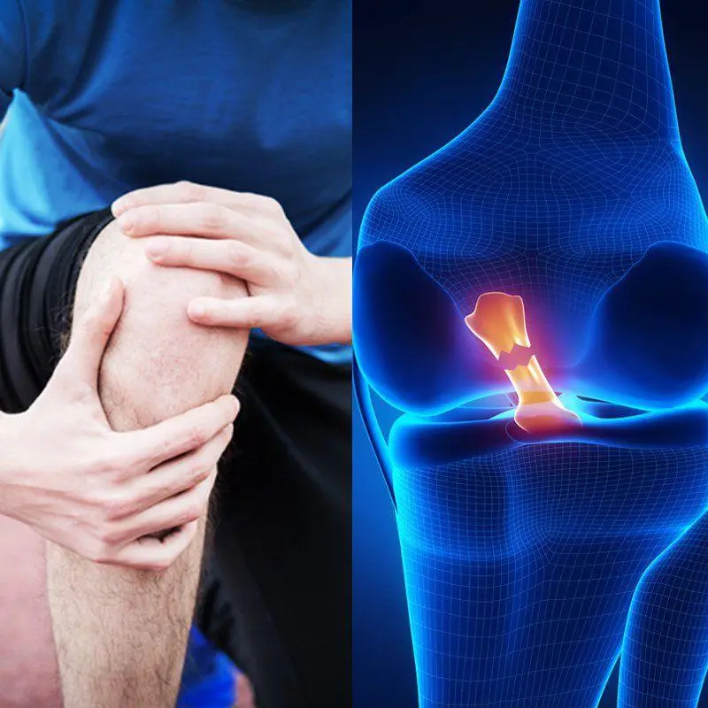 صورة توضيحية حول عملية الرباط الصليبي بالمنظار - د. محمد هطيف