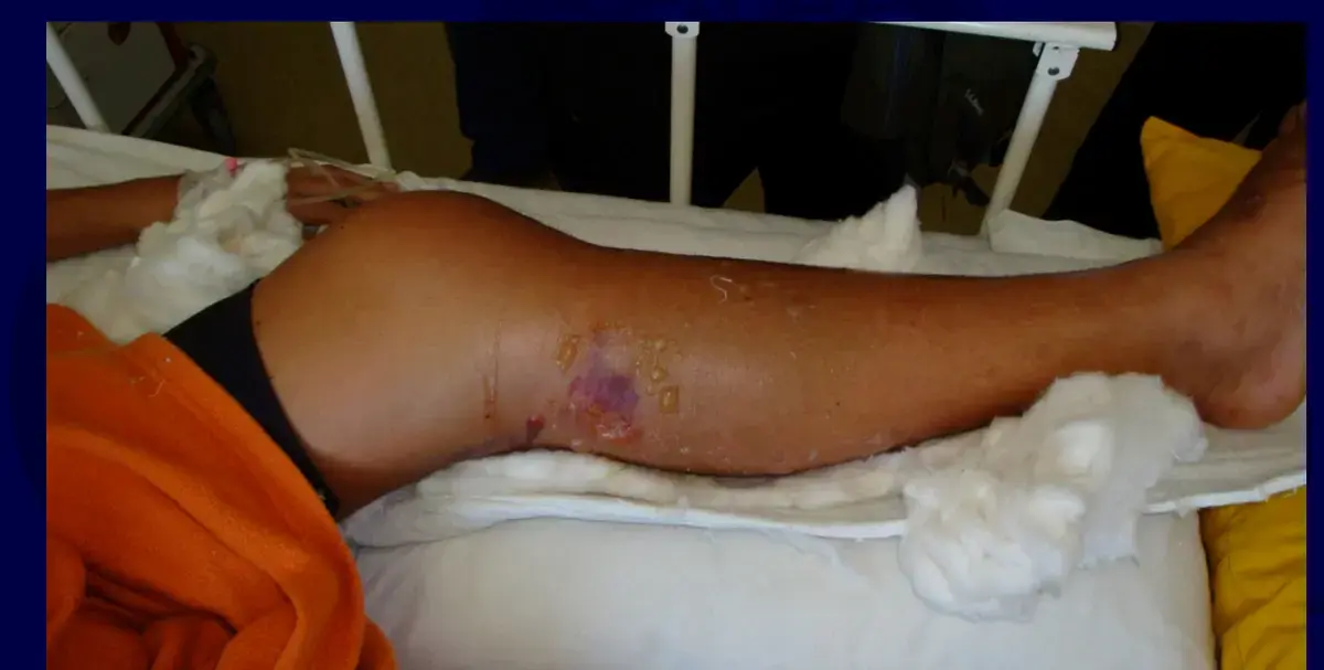 احم طفلك دليل شامل: الوقاية والعلاج لمشاكل العظام بالشلل الدماغي