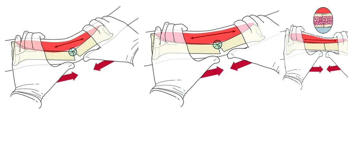 اكتشف أسرار الإدارة العظمية للشلل الدماغي: دليلك الحديث والشامل