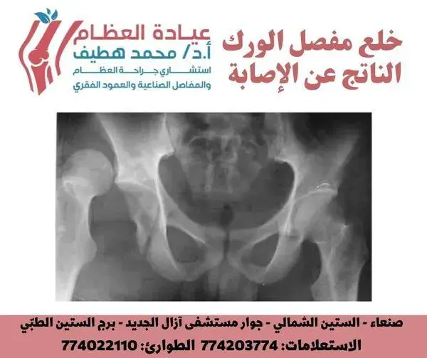 Hip Dislocation Due to Injury: Causes, Symptoms & Urgent Care