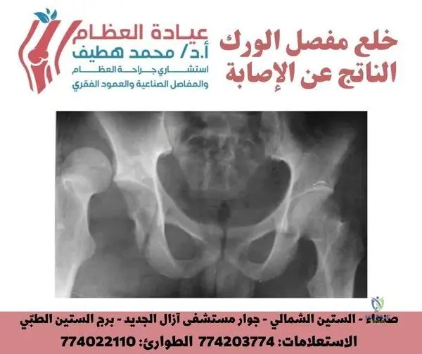 Illustration of hip dislocation due - Dr. Mohammed Hutaif