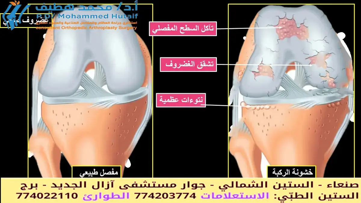 الوقايه من الاصابات الرياضية: دليلك للبقاء بعيداً عن مقاعد الاحتياط