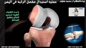 تغيير مفصل الركبة الكلي في اليمن