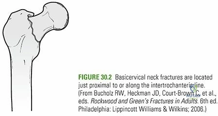 Illustration of unstable fracture patterns - Dr. Mohammed Hutaif