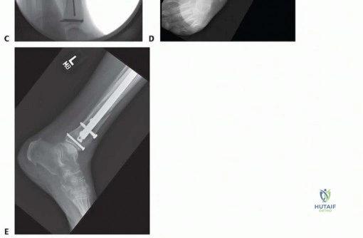 Illustration of proximal or distal - Dr. Mohammed Hutaif
