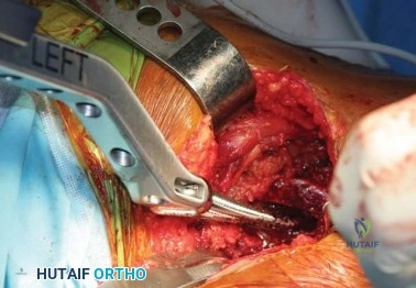 صورة طبية: الرقبة المعيارية Kinectiv® Stem لمفصل الورك الصناعي: حلول متطورة لنجاح جراحة استبدال مفصل الورك مع الأستاذ الدكتور محمد هطيف في صنعاء