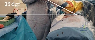 صورة طبية: الرقبة المعيارية Kinectiv® Stem لمفصل الورك الصناعي: حلول متطورة لنجاح جراحة استبدال مفصل الورك مع الأستاذ الدكتور محمد هطيف في صنعاء
