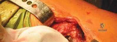 صورة طبية: الرقبة المعيارية Kinectiv® Stem لمفصل الورك الصناعي: حلول متطورة لنجاح جراحة استبدال مفصل الورك مع الأستاذ الدكتور محمد هطيف في صنعاء