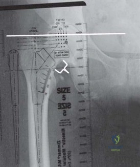 صورة طبية: الرقبة المعيارية Kinectiv® Stem لمفصل الورك الصناعي: حلول متطورة لنجاح جراحة استبدال مفصل الورك مع الأستاذ الدكتور محمد هطيف في صنعاء