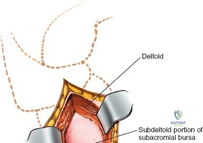 Proximal Humerus Lateral Approach: Comprehensive Guide to Anatomy & Surgical Technique