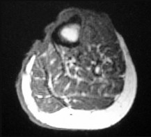 Orthopedic Board Review: Bone Dysplasias, Cysts & Synovial Chondromatosis | Part 20