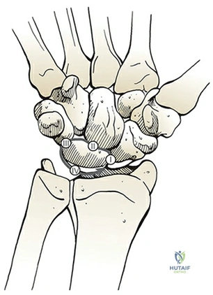 Mayfield stages of progressive perilunate instability