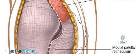 Illustration of parapatellar approach medial - Dr. Mohammed Hutaif