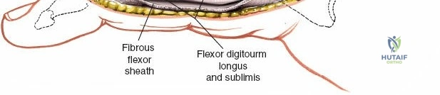 Illustration of flexor sheaths proximal - Dr. Mohammed Hutaif