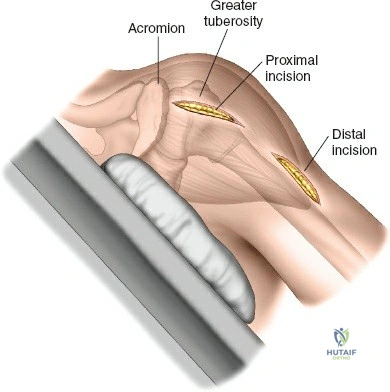 Illustration of minimally invasive lateral - Dr. Mohammed Hutaif