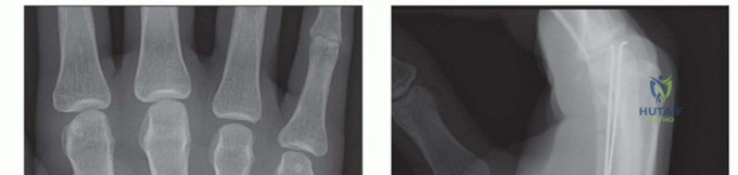 Intramedullary Nails and External Fixators: Advanced Biomechanics, Design Principles, and Clinical Performance