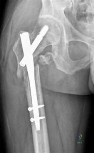 Illustration of orthopaedic knowledge update sports - Dr. Mohammed Hutaif