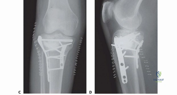 Illustration of bicondylar tibial plateau - Dr. Mohammed Hutaif