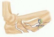 Illustration of fractures in adults - Dr. Mohammed Hutaif