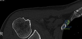 Mastering Open Reduction and Internal Fixation in Hand Trauma: Screws, Plates, and Wiring Techniques