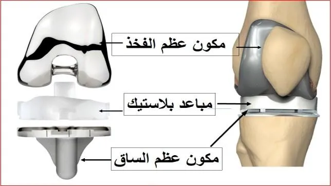 مكونات مفصل الركبة الصناعي