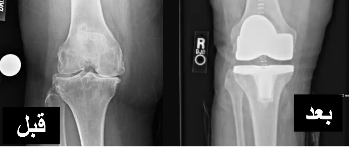 أشعة ركبة قبل وبعد تركيب المفصل الصناعي