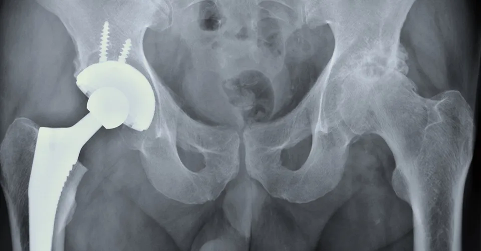 أشعة قبل وبعد زراعة مفصل الورك