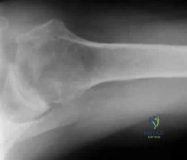 Orthopedic Surgery Board Review MCQs: AAOS Master Bank Part 127