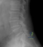 Orthopedic Board Review MCQs: Knee Arthroplasty, Revision & Spine - Part 147